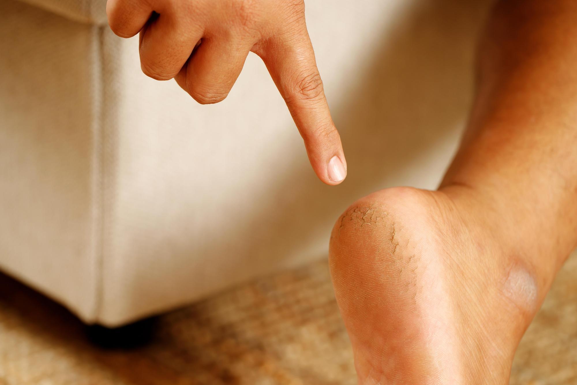 Nấm Kẽ Chân Mùa Mưa: Nhận Biết, Điều Trị Tại Nhà Và Cách Phòng Tái Phát